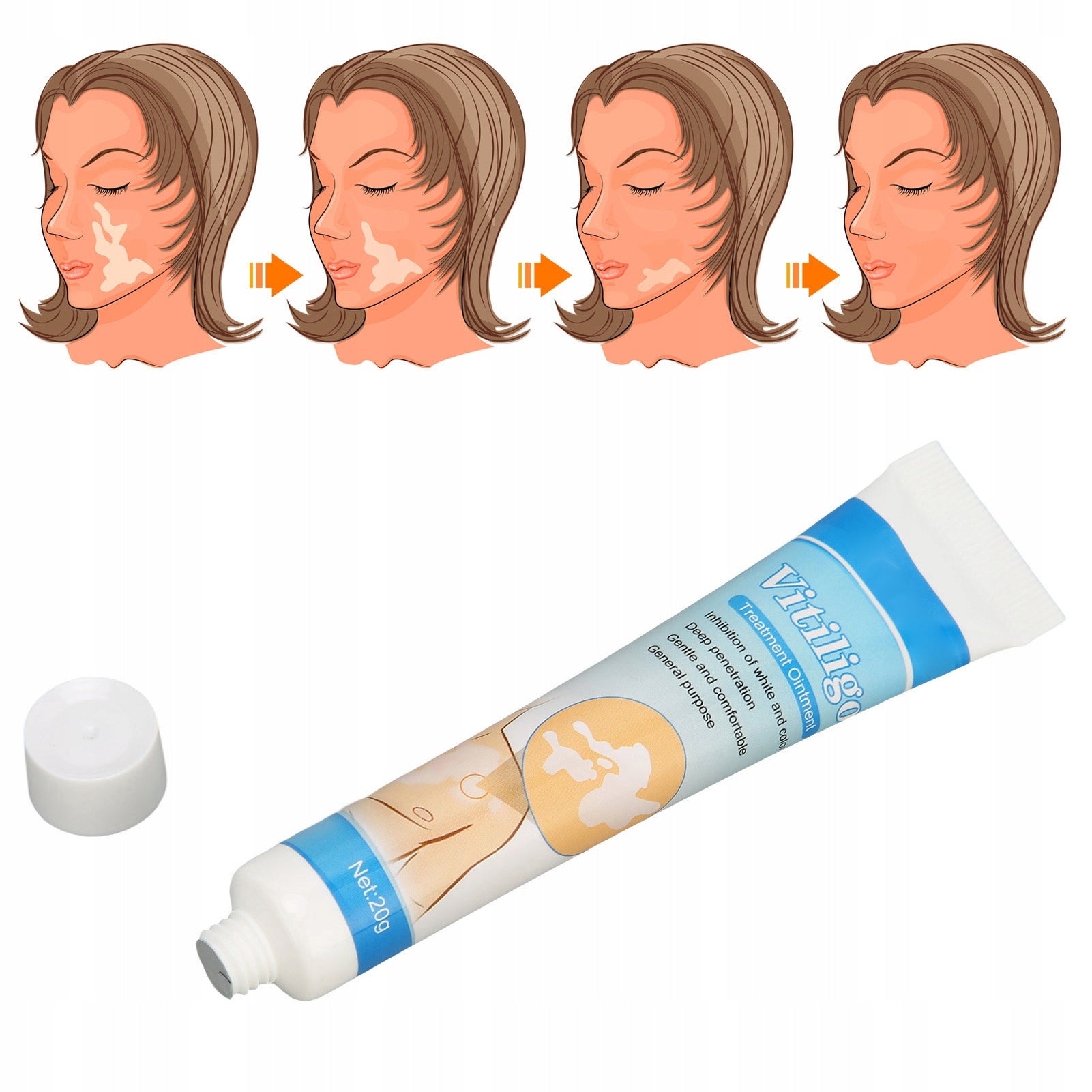VITILIGO TREATMENT OINTMENT FOR SKIN PIGMENTATION 20G VITILIGO CREAM